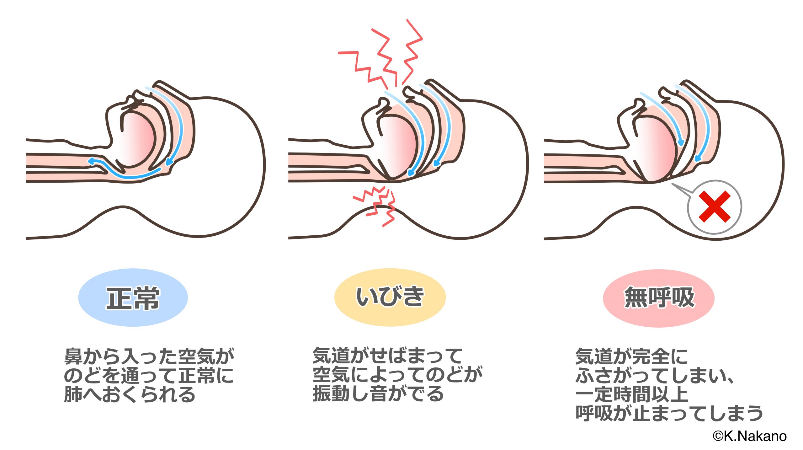 睡眠時無呼吸のおこるメカニズムの解説。いびき、無呼吸は、舌根の沈下により、気道がせまくなったり、閉塞することでおこります