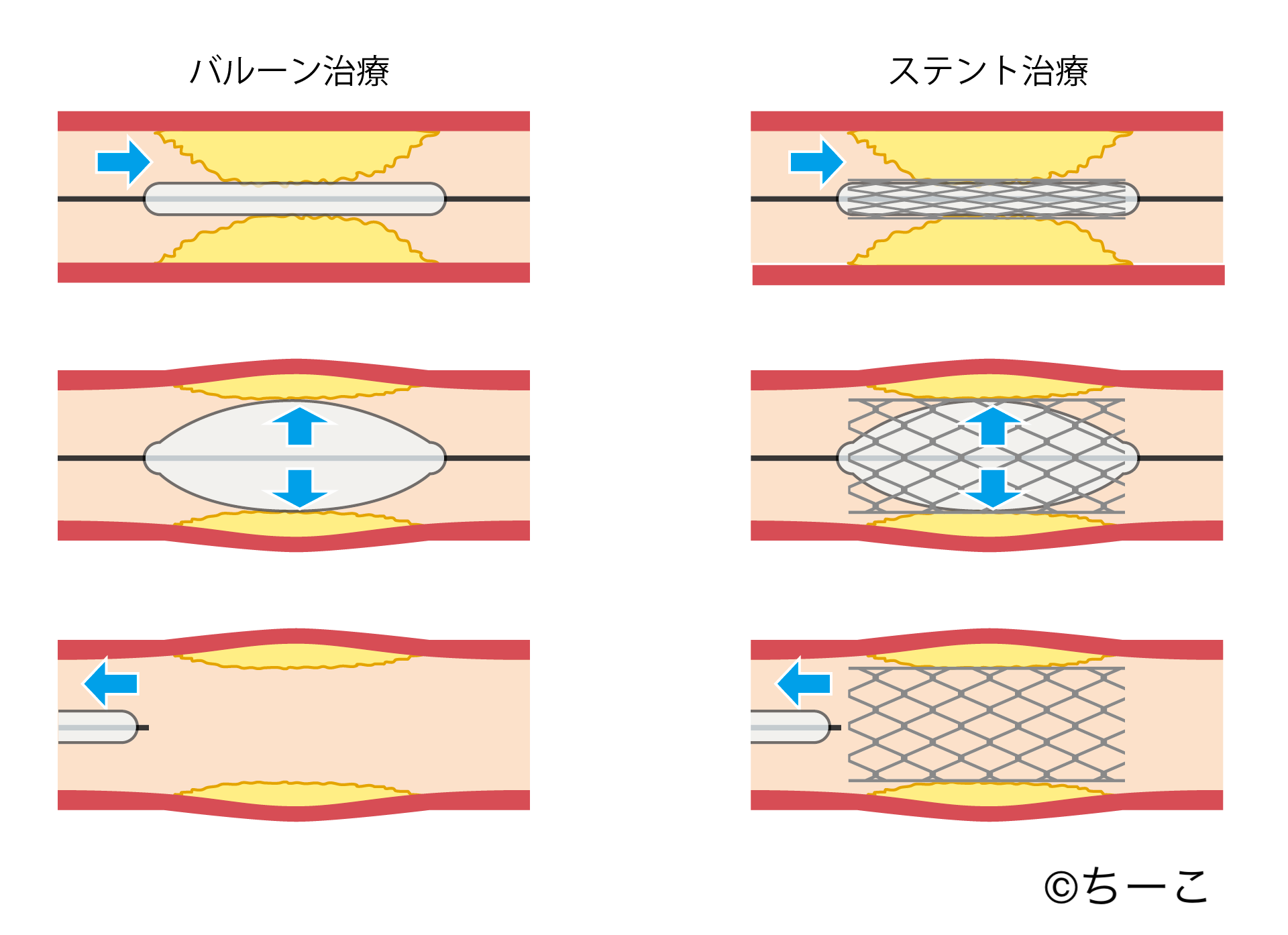 PCI