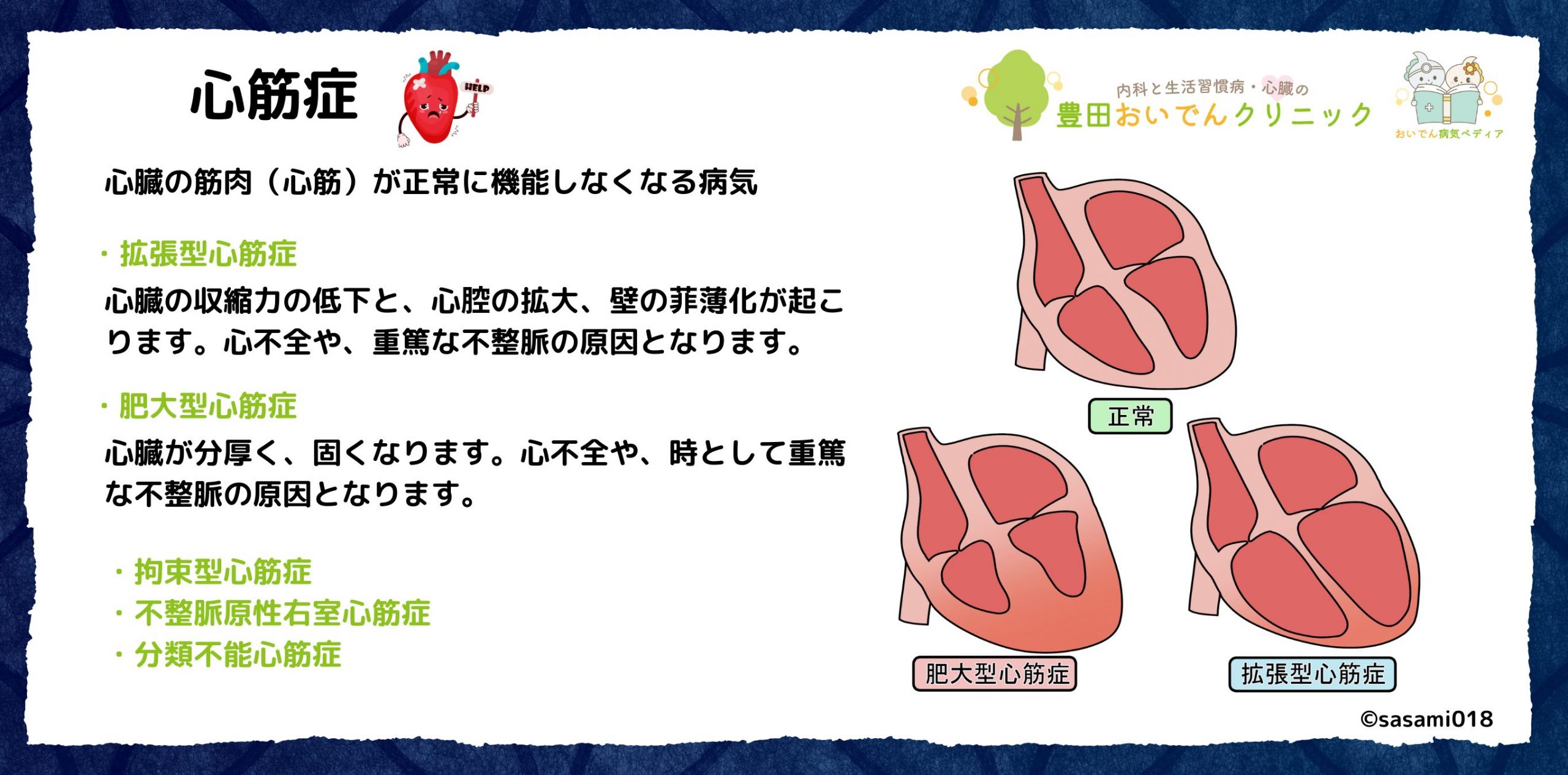 心筋症の説明。拡張型心筋症。肥大型心筋症。不整脈原性右室心筋症。拘束型心筋症