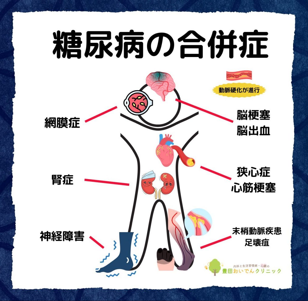 糖尿病の合併症。網膜症、腎症、神経障害、脳梗塞、脳出血、狭心症、心筋梗塞、足病変、末梢動脈疾患