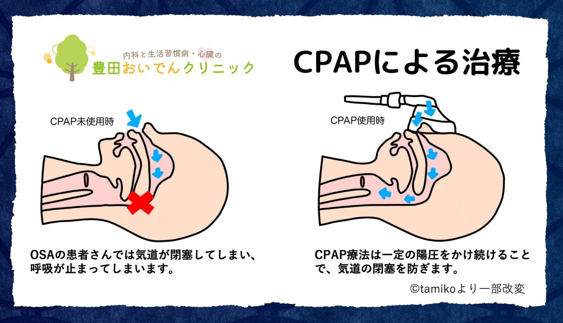 CPAPによる治療の説明図。CPAP療法は、気道に一定の陽圧をかけることで、気道の閉塞を防ぎます。