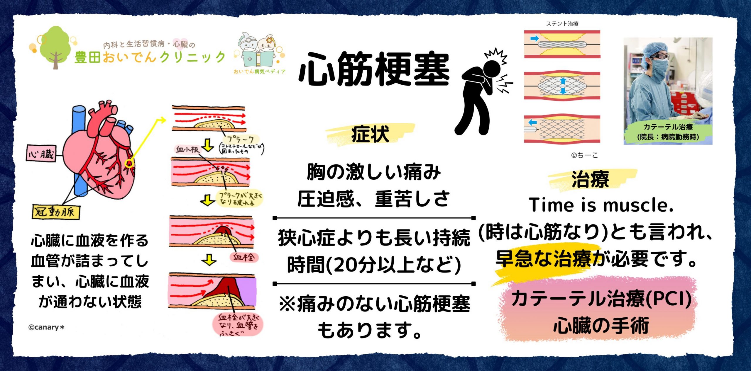 心筋梗塞の説明：心臓の血管がプラークラプチャーにより、閉塞し、心臓に血液が通わなくなります。：症状：胸の痛み・不快感 圧迫感、重苦しさ：肩、腕、首、顎、背中への放散痛。：多くは、労作時。 重症では、安静時も。治療：カテーテル、手術