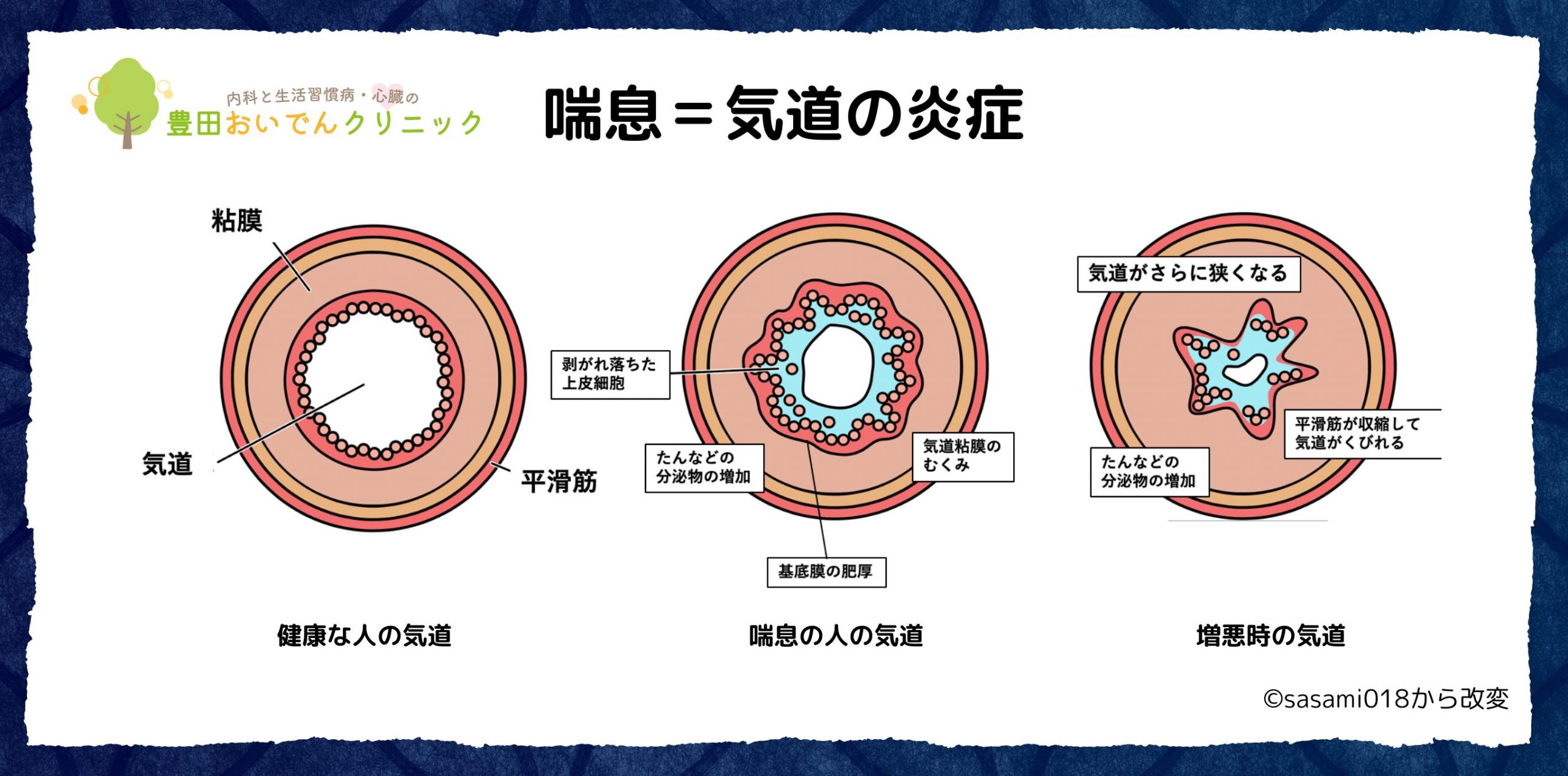 喘息とは気道の炎症です。健康な人、喘息の人、増悪時の気道の状態を説明。分泌物の増加。気道の攣縮。