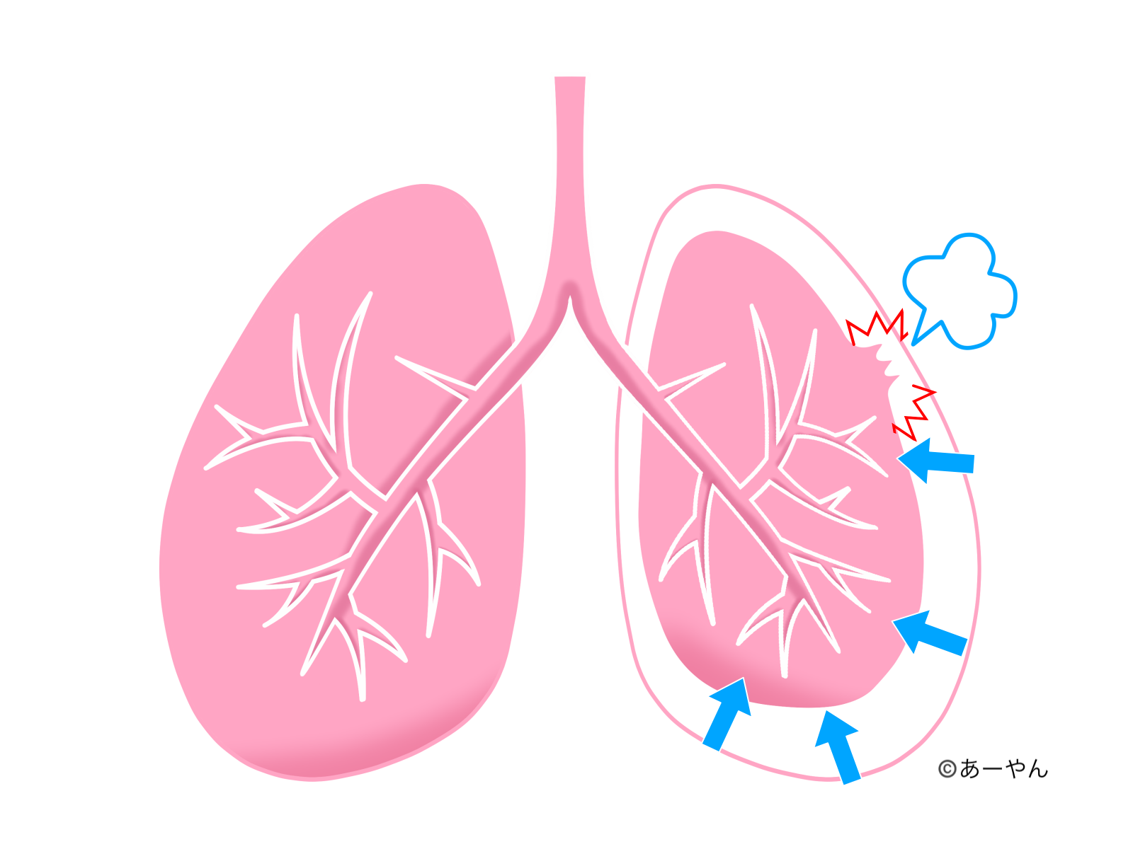 気胸の原理の説明